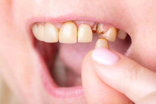 What Can A Dentist Do For A Broken Tooth?