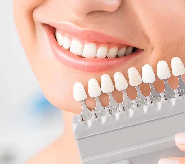 https://www.missionfamilydentalslo.com/wp-content/uploads/dental-veneers-and-dental-laminates.jpg